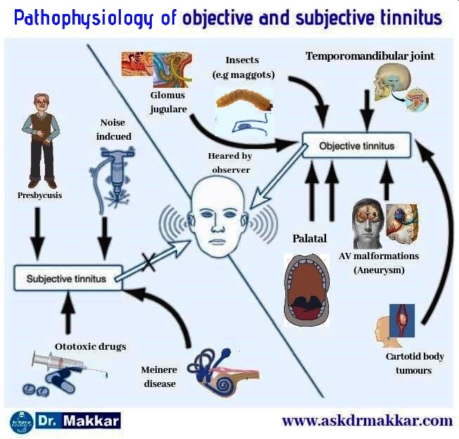 Types of Tinnitus :Tinnitus is classified medically as Objective & subjective tinnitus || टिनिटस के प्रकार: टिनिटस को चिकित्सकीय रूप से वर्गीकृत किया गया है उद्देश्य और व्यक्तिपरक टिनिटस।