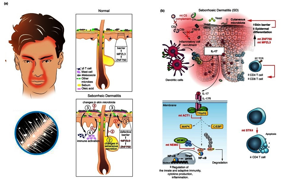 Pathophysiology of seborrhic Dermatitis