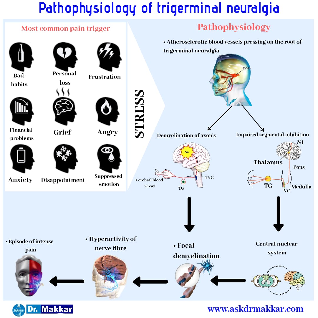 Pathophysiology of trigerminal neuralgia