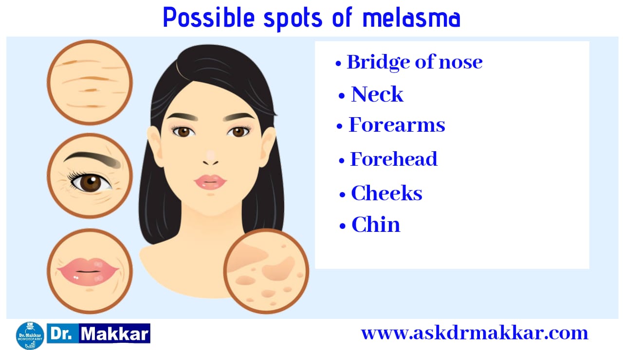 Pattern of spot on face