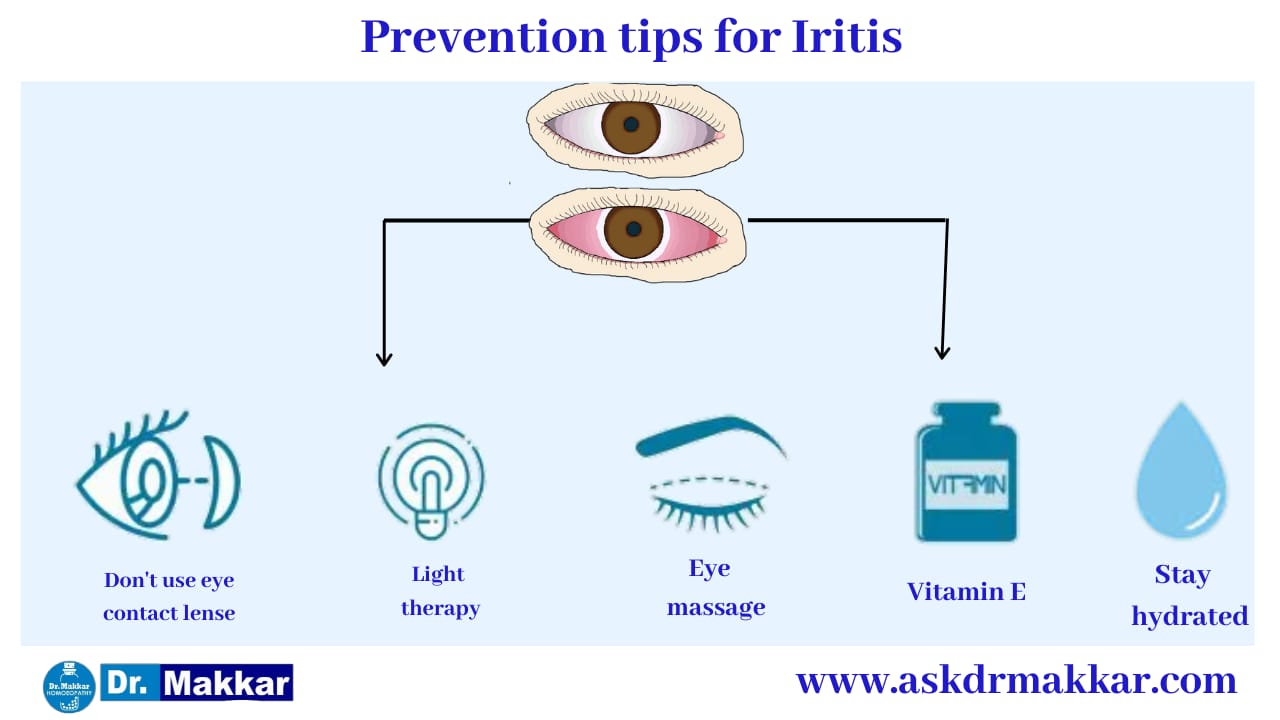 Preventive for Iritis Anterior Uveitis || "एंटीरियर यूवाइटिस" या इरिडोसाइक्लाइटिस की रोकथाम के कदम 