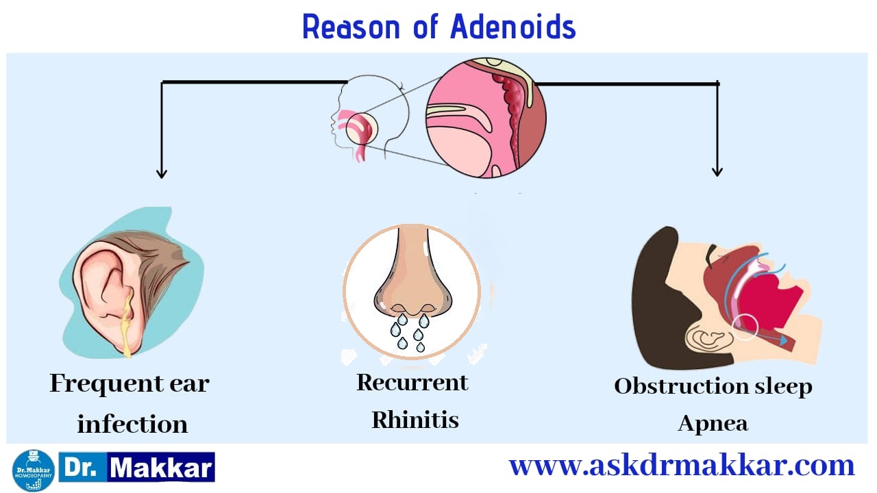 Reason of adenoid development in childrens