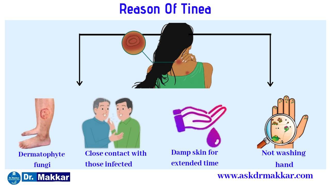 Reason of tinea 