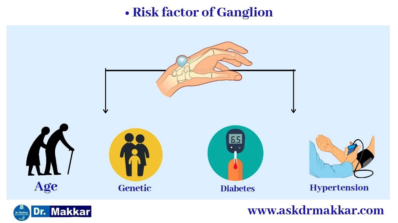 Risk factors for Ganglion wrist  ||  नाड़ीग्रन्थि गांठ गांठ के जोखिम कारक