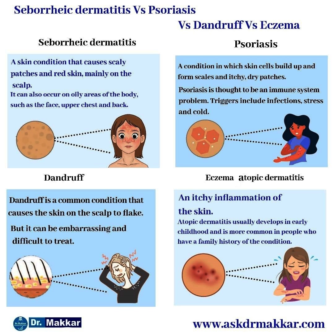 Seboorhic dermatitis vs psoriasis vs atrophic dermatitis vs dandruff diffrential diagnosis