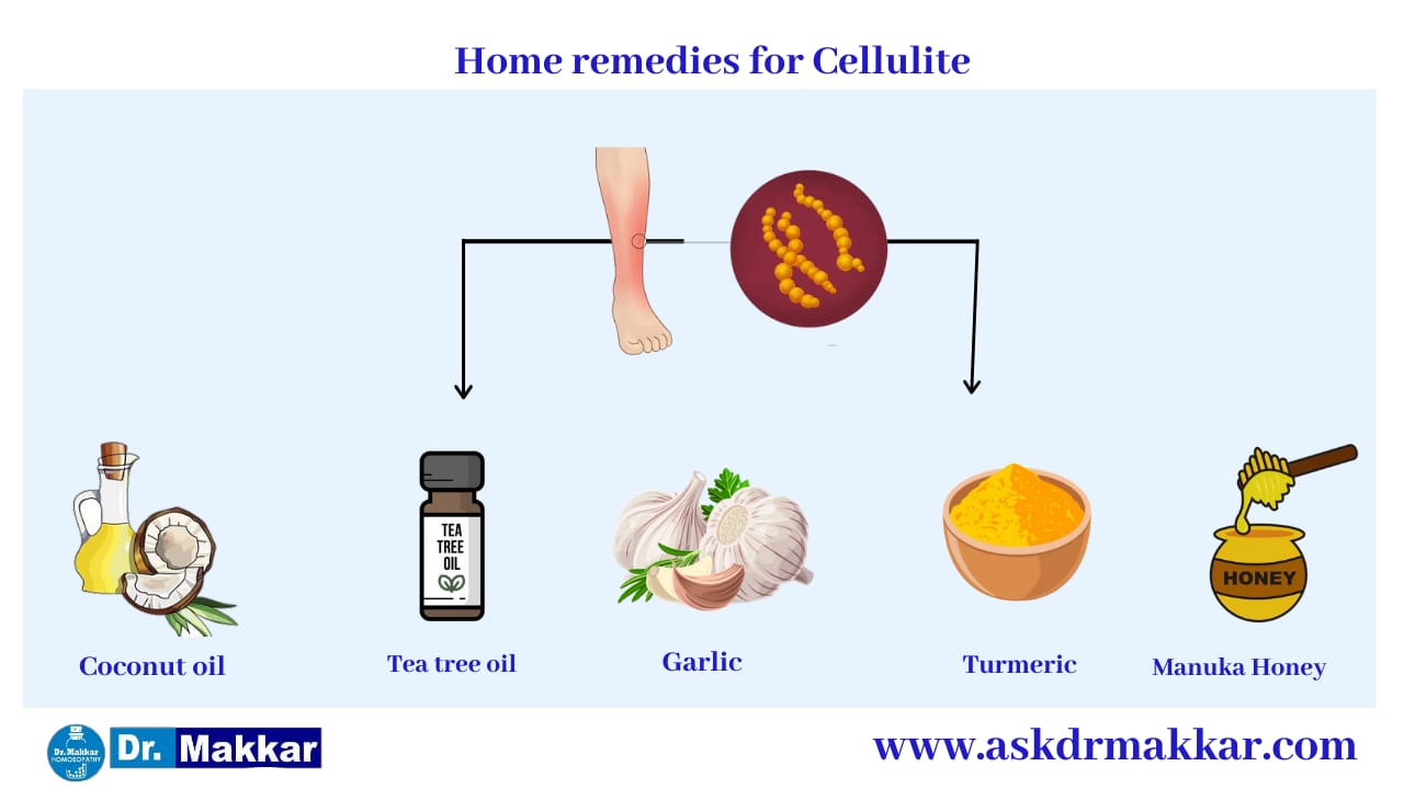 Self Care Home based Remedies Measure to tackle Cellulitis Skin Infection   सेल्फ केयर होम आधारित उपचार सेल्यूलाइटिस स्किन इंफेक्शन रीज़न  निपटने के उपाय