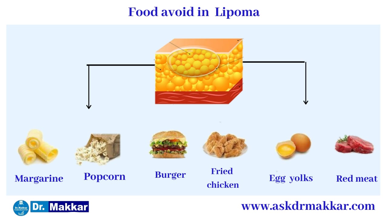 Self Care Home based Remedies Measure to tackle Lipoma Benign Tumour under skin || चर्बी की गांठ लिपोमा सेल्फ केयर होम आधारित उपचार चर्बी की गांठ लिपोमा रीज़न  निपटने के उपाय