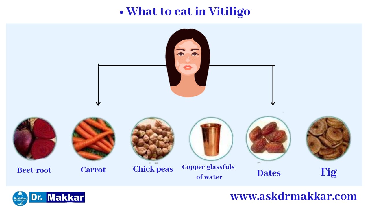 Self Care Measure for Vitiligo Leucoderma white patches   विटिलिगो ल्यूकोडर्मा सफेद दाग के घरेलू उपचार आत्म देखभाल उपाय