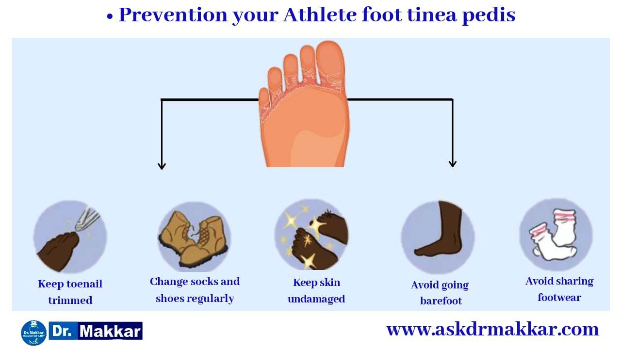 Self care measure in tinea pedis or athlete feet || टिनिया पेडिस या एथलीट फीट में सेल्फ केयर माप को जड़ से खत्म करने के उपाय