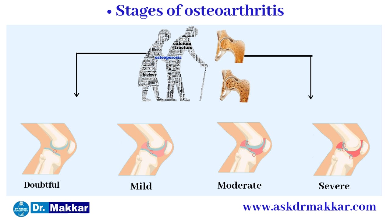 Stage for Osteoarthritis 