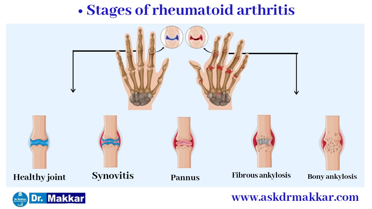 Stages leads heathy joint to ankylosed joint to Rheumatoid arthritis