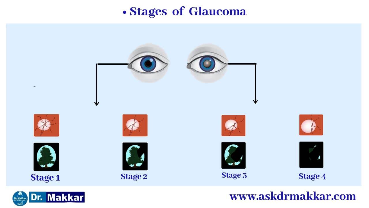 Stages of Glaucoma ||  ग्लूकोमा के चरण