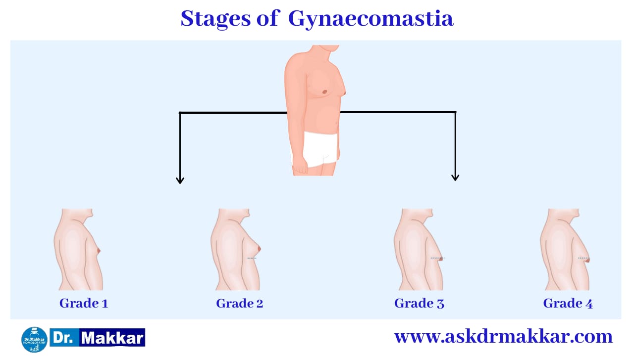 Stages of Gynecomastia Enlarged Male Breast Tissue || ज्ञ्नेकोमास्टिया बढ़े हुए पुरुष स्तन ऊतक के चरण