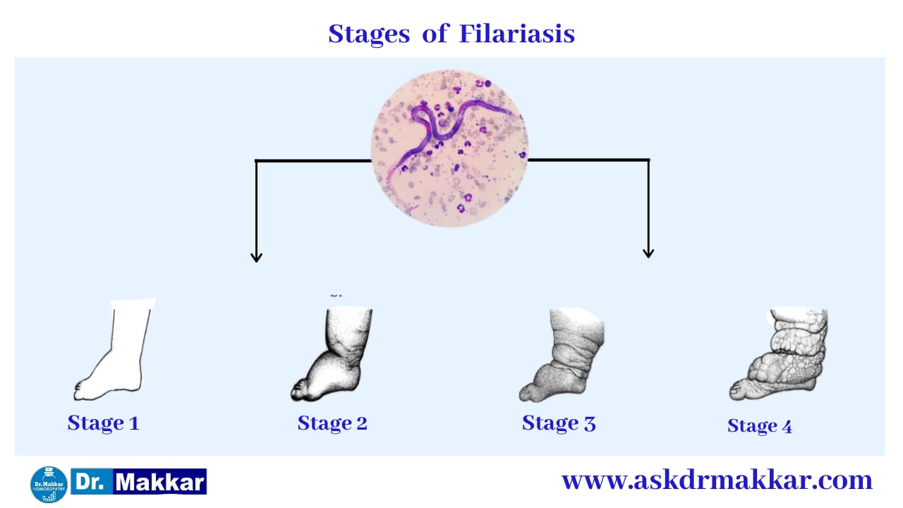 Stages of Lymphatic Filariasis elephantiasis  लसीका फाइलेरिया हाथी पांव  के चरण