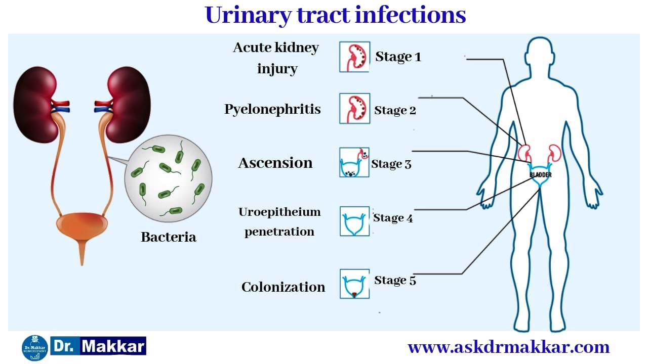 Stages of UTI Urinary Tract Infection Cystitis