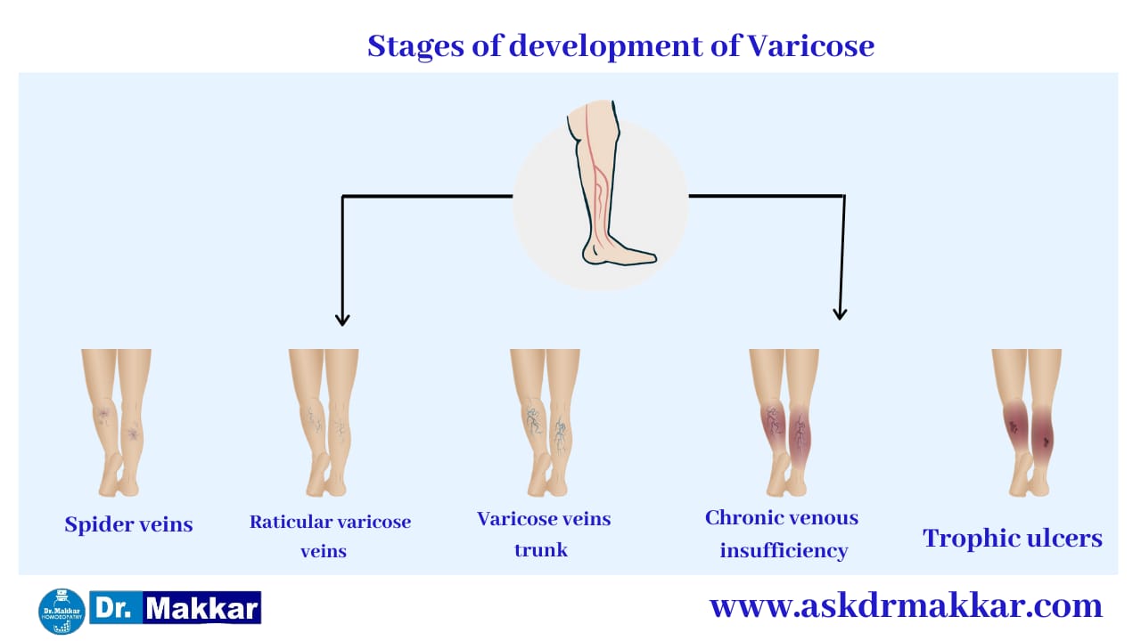 Stages of Varicose Veins  वैरिकाज़ नसों के चरणों के विकास के कारण