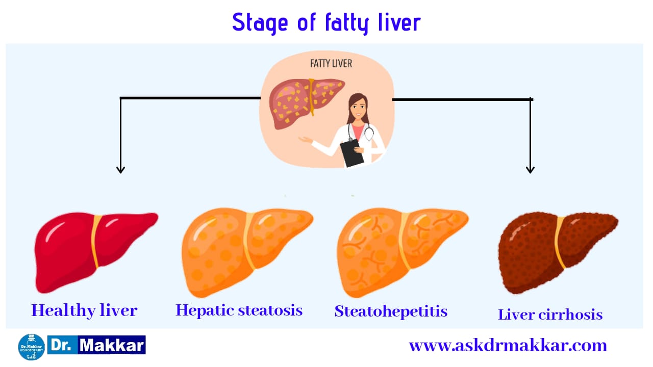 Stages of fatty liver to cirrhosis