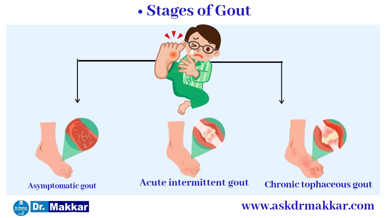 Stages of gout acute chronic  asmptomatic