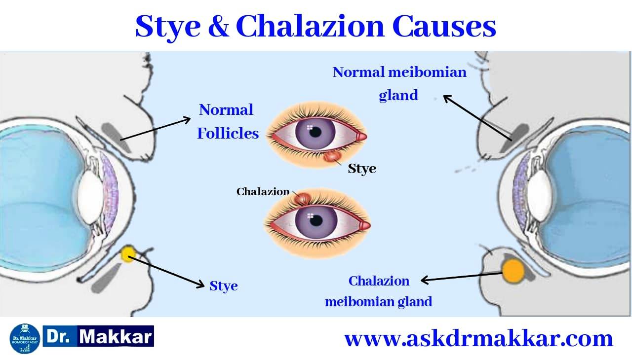 Reason for Stye vs Chalazion causes of formation behind it 