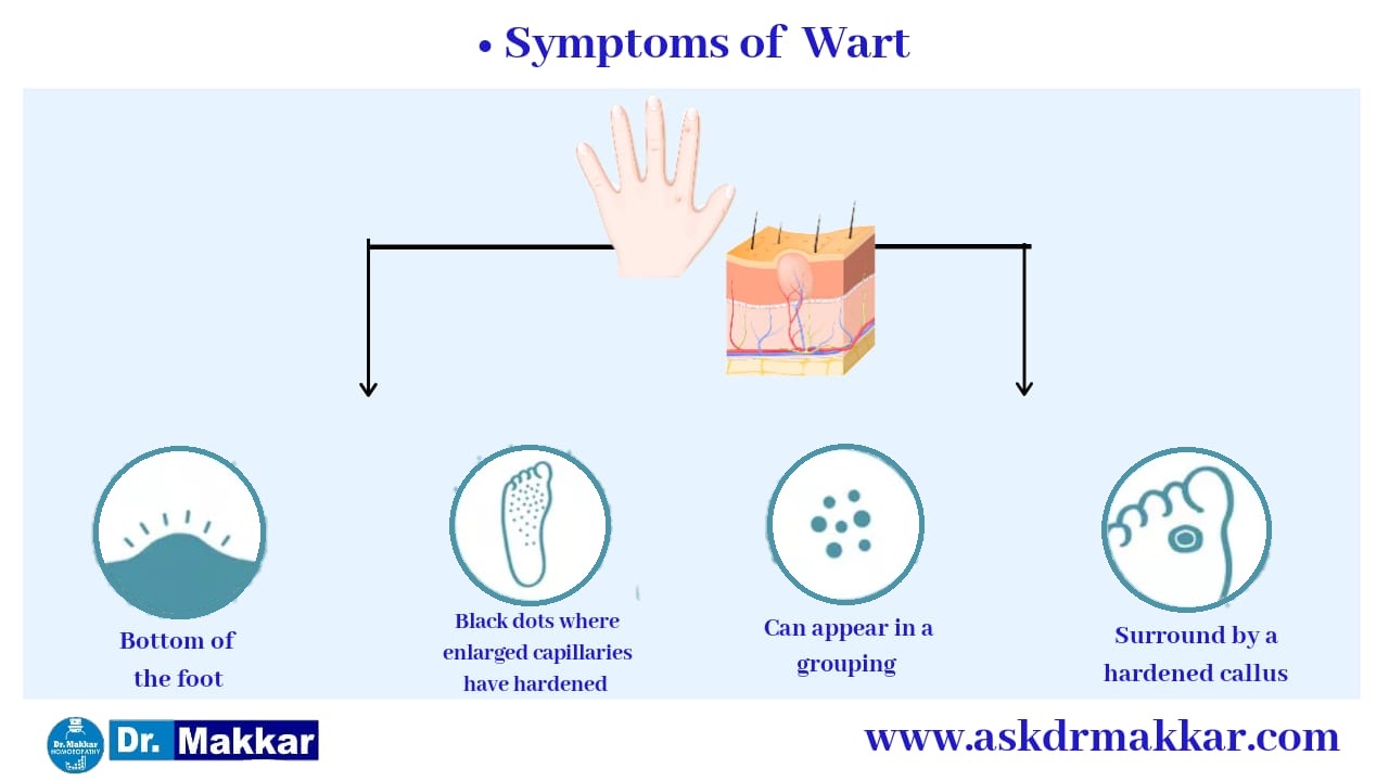 Symptomatic analysis appearance of Warts || कॉमन वार्ट्स मस्सों केलक्षण 