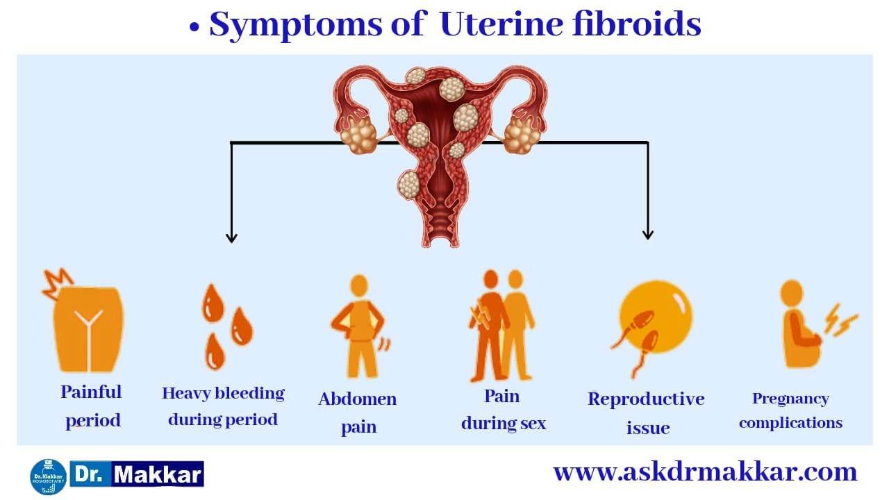 Symptoms & Signs of Uterine fibroid which also called as myoma || गर्भाशय फाइब्रॉएड के लक्षण और संकेत जिन्हें मायोमा भी कहा जाता है