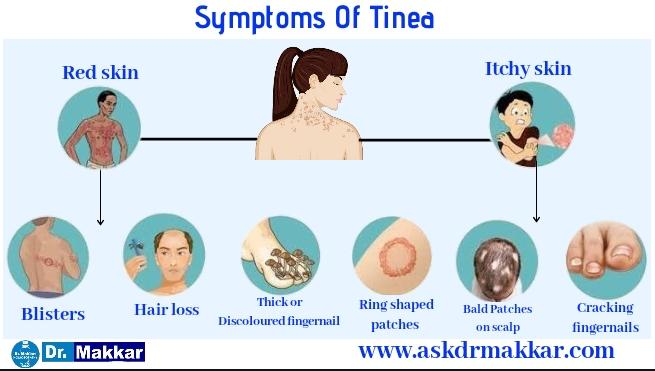 Symptoms of Tinea Ringworm