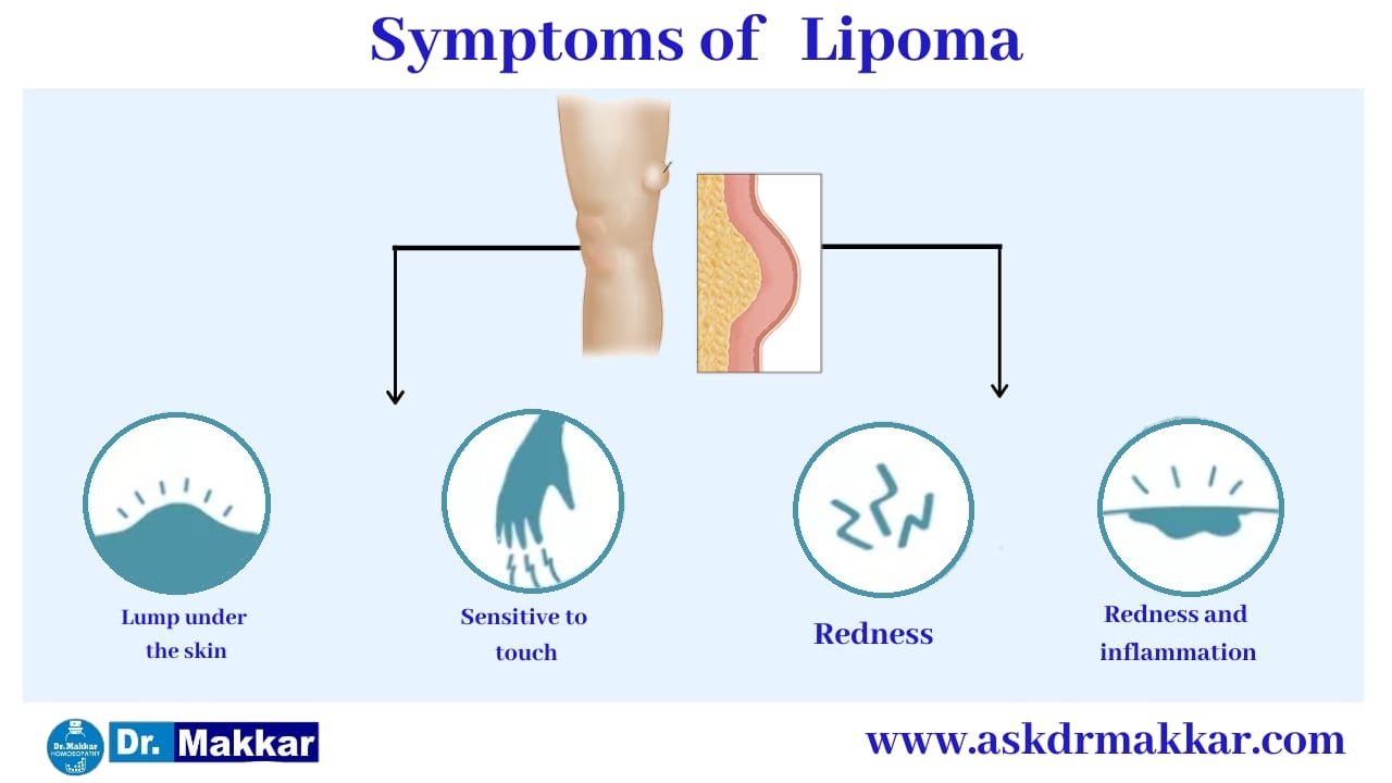 Symptoms of   Lipoma Benign Tumour under skin || चर्बी की गांठ लिपोमा के लक्षण