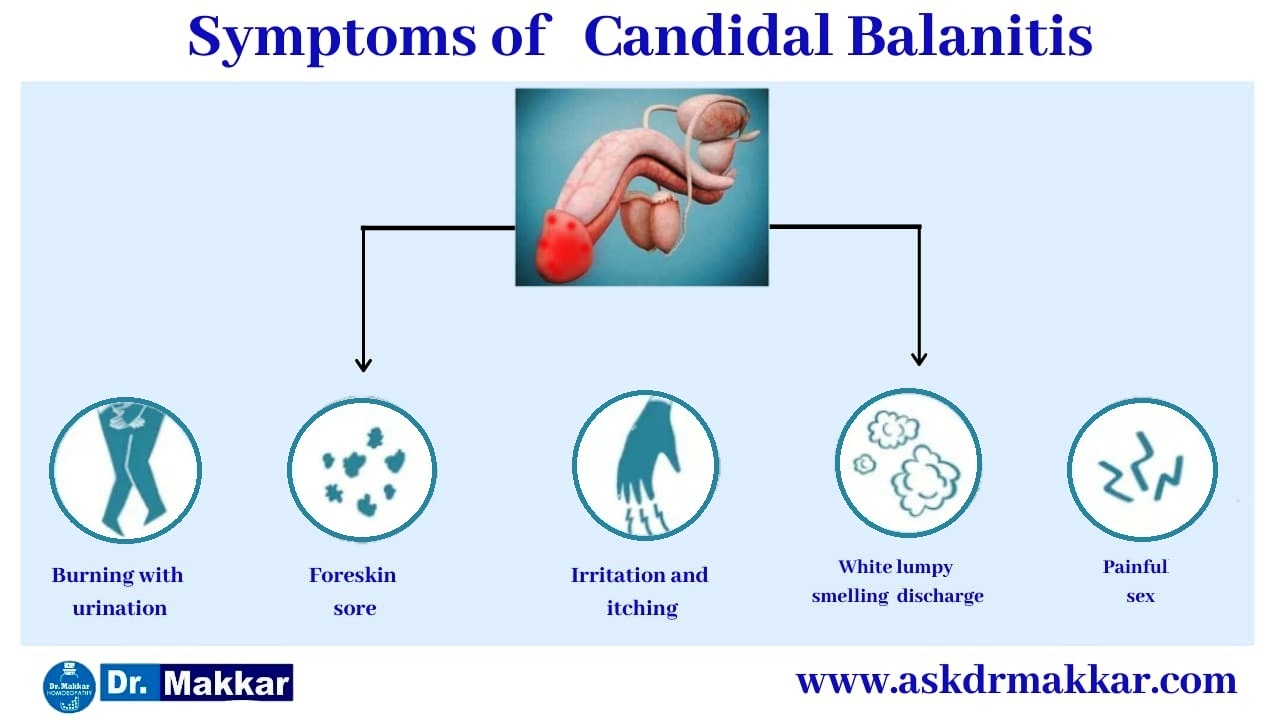 Symptoms of  Balanitis || बैलेनाइटिस के लक्षण