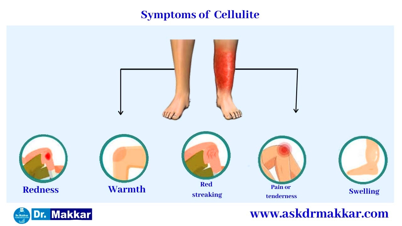 Symptoms of  Cellulitis Skin Infection || सेल्यूलाइटिस स्किन इंफेक्शन के लक्षण