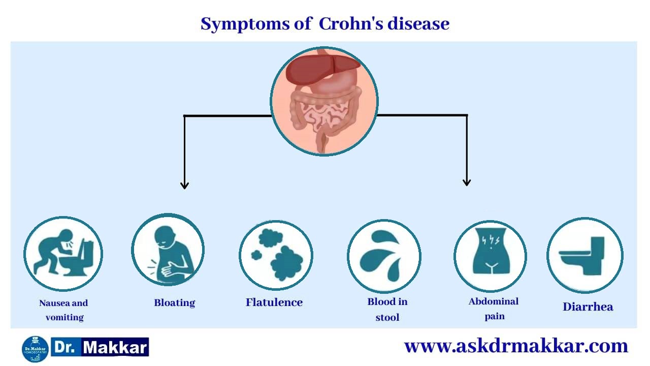 Symptoms of  Crohns Disease Inflammation of intestine || आंतों में सूजन क्रोहन रोग के लक्षण