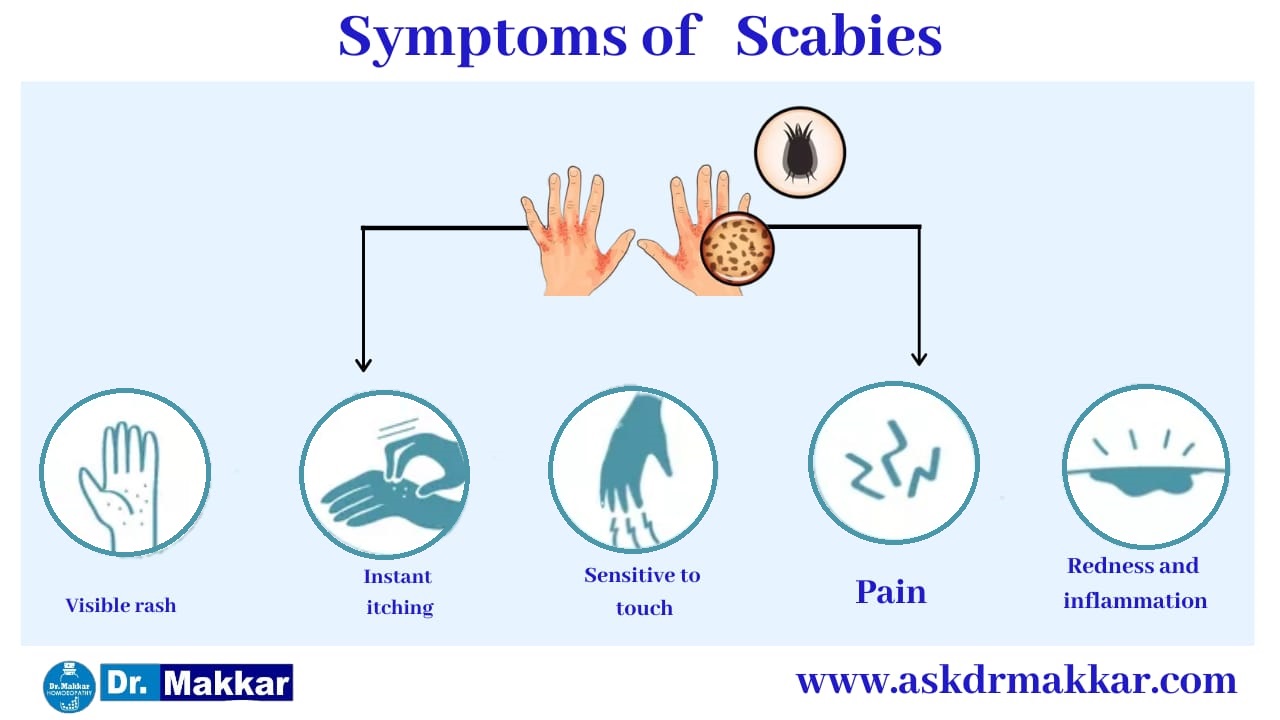 Symptoms of  Scabies || स्केबीज या खाज के लक्षण