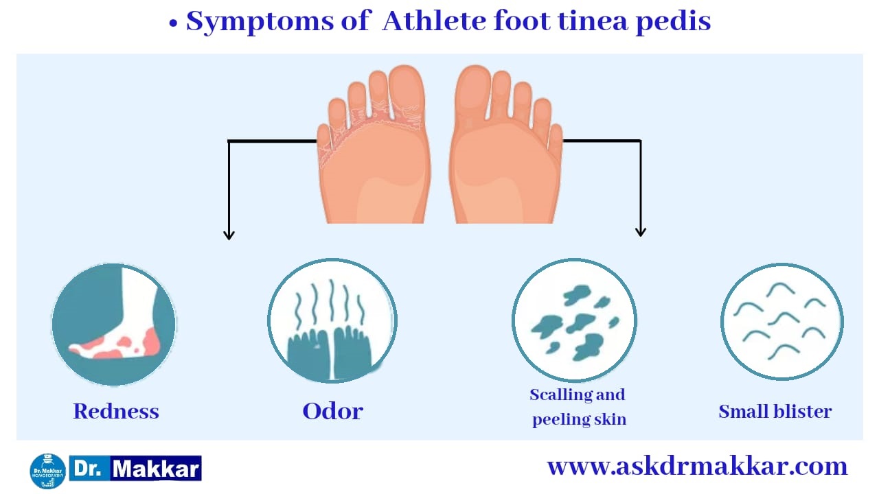 Symptoms of Athlete foot Tinea pedis || एथलीट फुट टीनिया पेडिस के लक्षण 