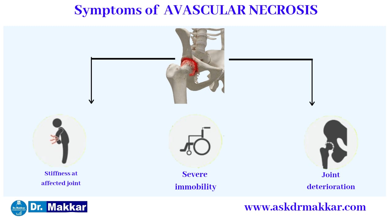 Symptoms of Avascular Ischemic Necrosis AVN Osteonecrosis femur || एवस्कुलर इस्केमिक नेक्रोसिस एवीएन ओस्टियोनेक्रोसिस फीमर हड्डी के लक्षण