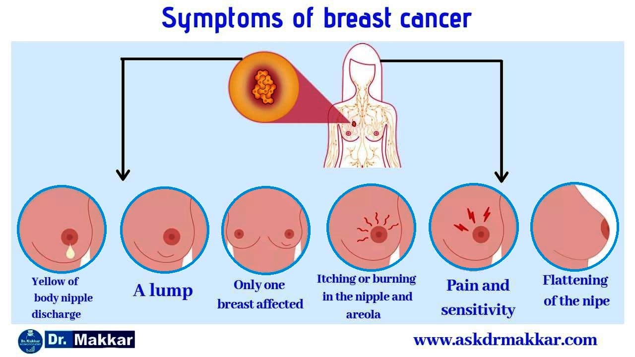 	Symptoms of Breast tumour leads to Breast cancers