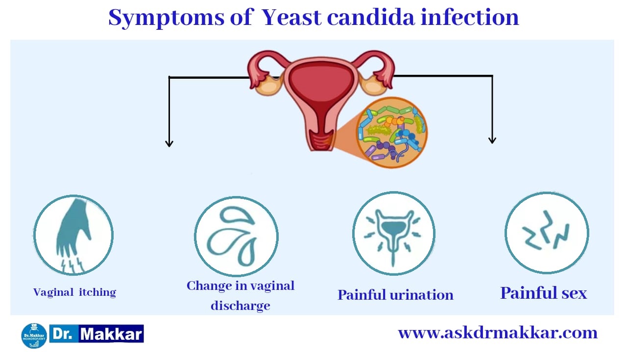 Symptoms of Candida ||  यीस्ट इन्फेक्शन इन वेजिना में जलन के लक्षण