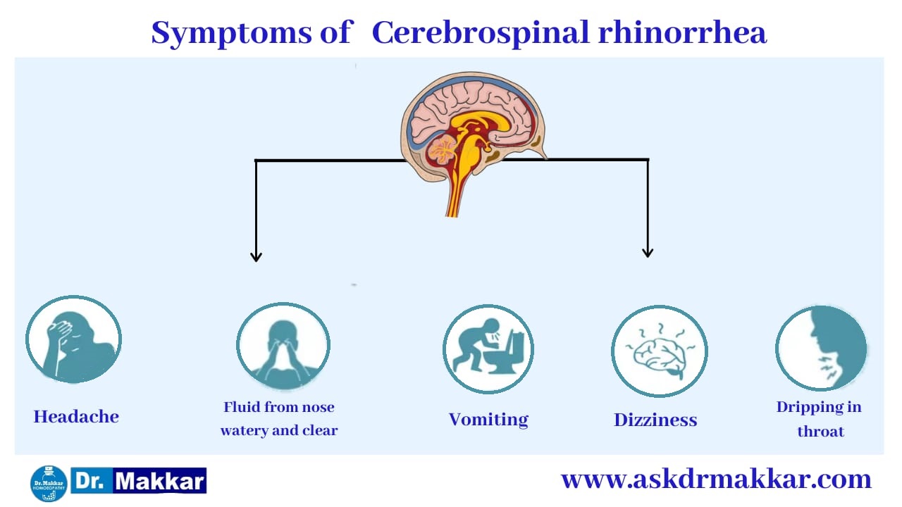 Symptoms of Cerebrospinal Fluid (CSF) Leak Rhinorrhea || सेरिब्रल स्पाइनल फ्लूइड लीक रिसाव राइनोरिया के लक्षण
