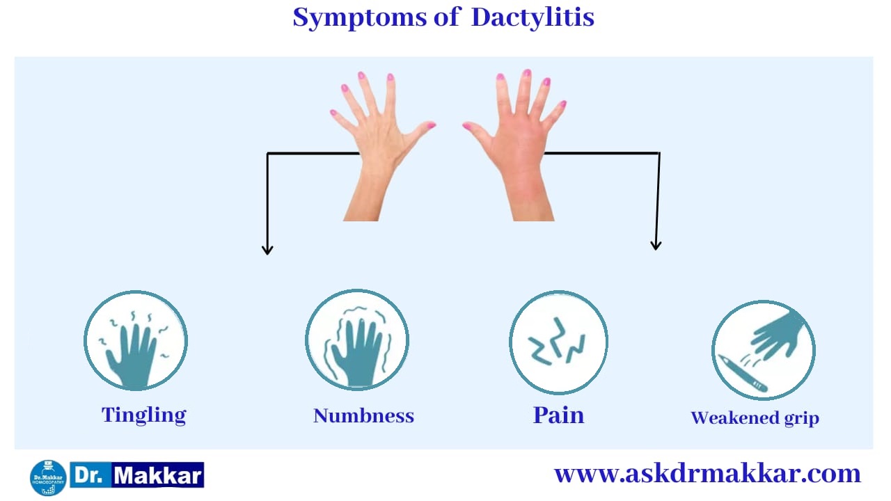 Symptoms of Dactylitis Swelling in Toes & Fingers || डक्टाइलिटिस के लक्षण हाथ पैरों की सूजन 