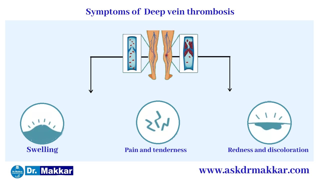 Symptoms of Deep Vein Thrombosis DVT || डीप वेन थ्राम्बोसिस डीवीटी  के लक्षण