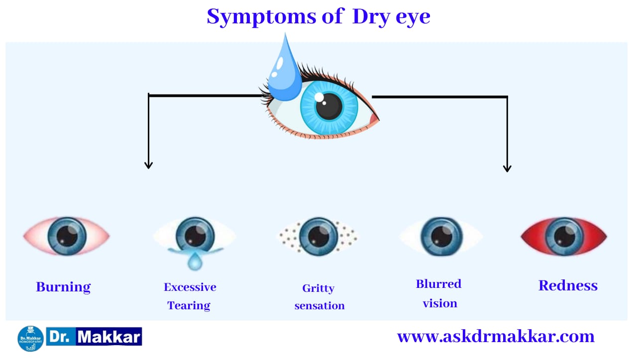 Symptoms of Dry Eye Keratoconjunctivitis  सूखी आँख केराटोकोनजक्टवाइटिस के लक्षण