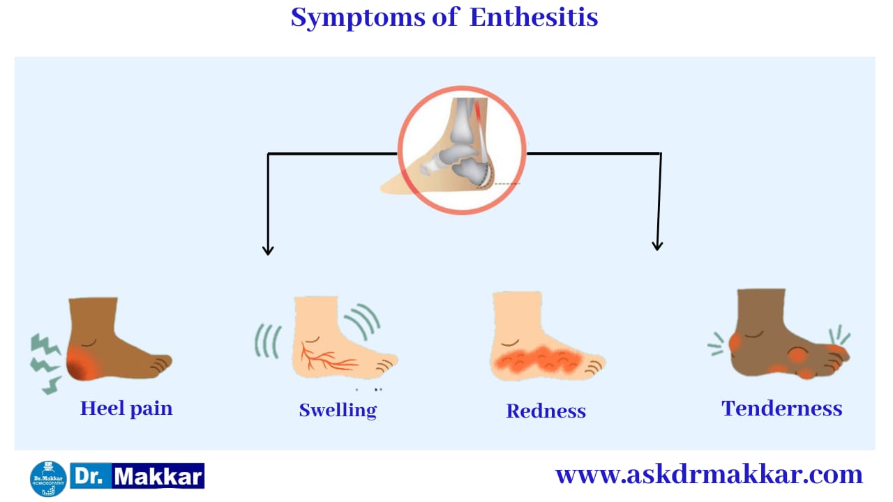 Symptoms of Enthesitis SpondyloArthritis || एंथेसिसिटिस स्पोंडिलोआर्थराइटिस के लक्षण