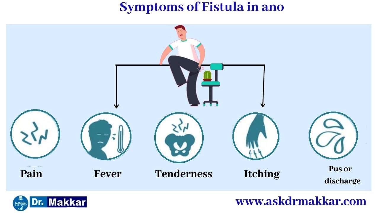 Symptoms of Fistula also called as fissure in ano  || भगन्दर एनल फिस्टुला के लक्षण