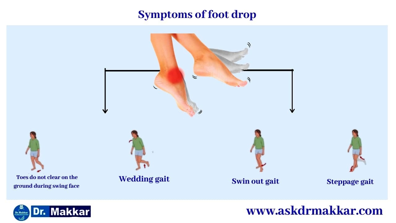 Symptoms of Foot Drop Peroneal Nerve || फुट ड्राँप अनुजंघास्थिक तंत्रिका के लक्षण