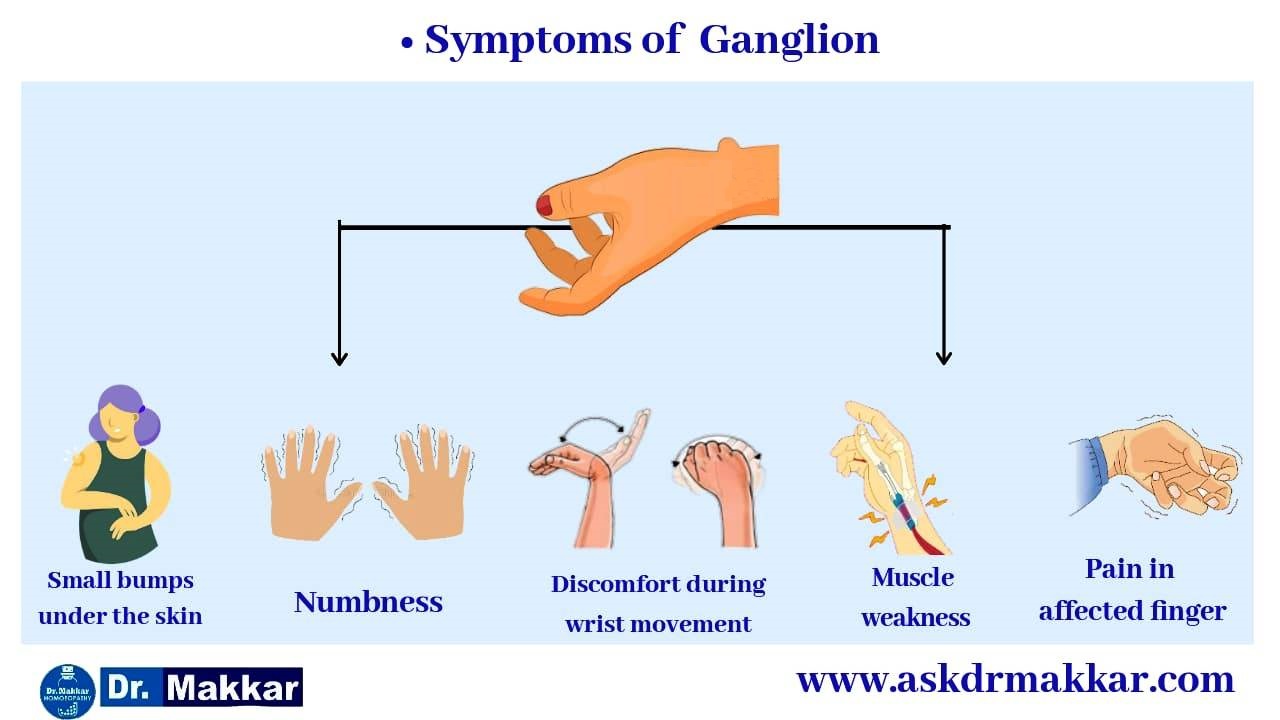 Symptoms of Ganglion Cyst  ||  नाड़ीग्रन्थि गांठ गांठ के लक्षण