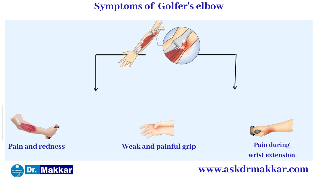 Symptoms of Golfers Elbow  || गोल्फर एल्बो के लक्षण