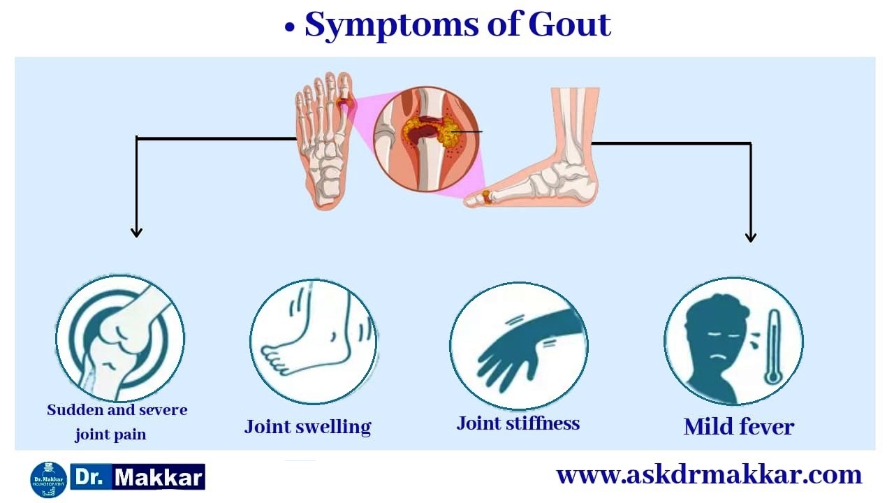 Symptoms of Gout Uric Acid