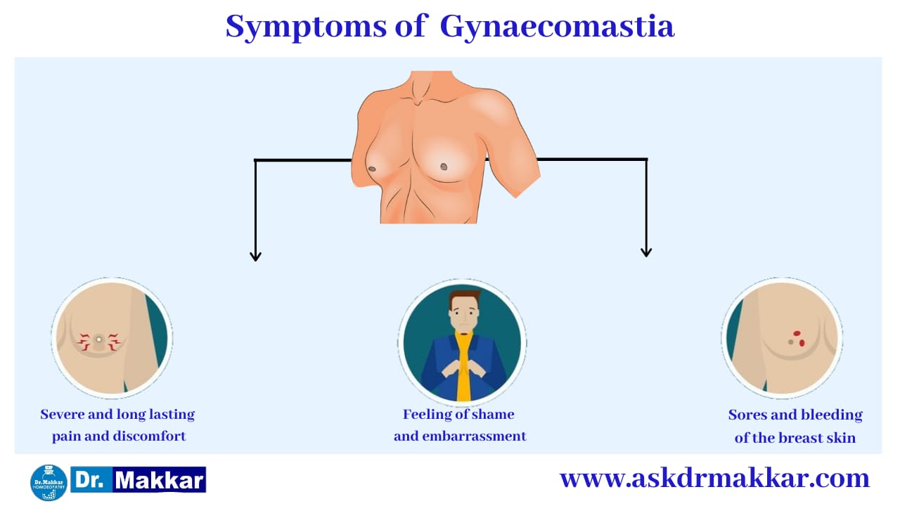Symptoms of Gynecomastia Enlarged Male Breast Tissue || ज्ञ्नेकोमास्टिया बढ़े हुए पुरुष स्तन ऊतक के लक्षण