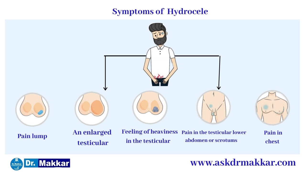Symptoms of Hydrocele  || हाइड्रोसेले के लक्षण