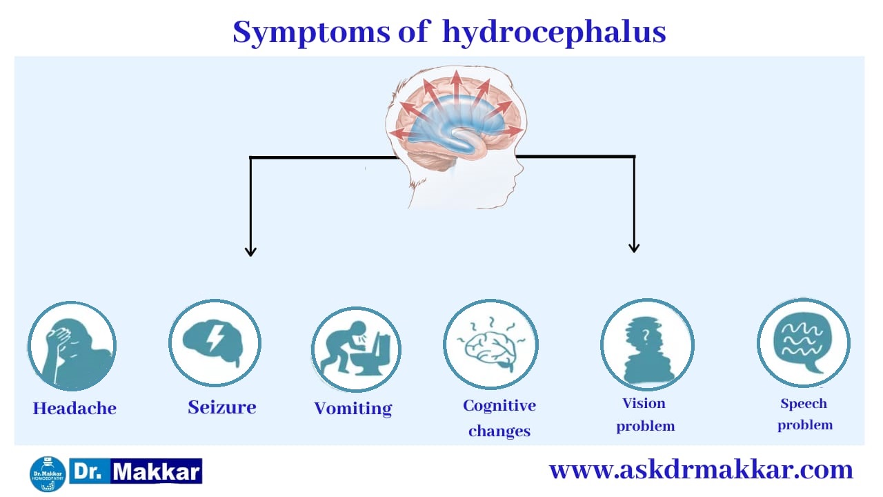 Symptoms of Hydrocephalus || जलशीर्ष हाइड्रोसेफ़लस के लक्षण