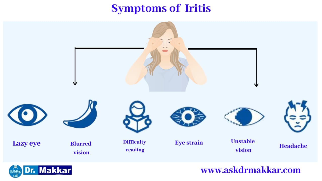 Symptoms of Iritis Anterior Uveitis || "एंटीरियर यूवाइटिस" या इरिडोसाइक्लाइटिस के लक्षण