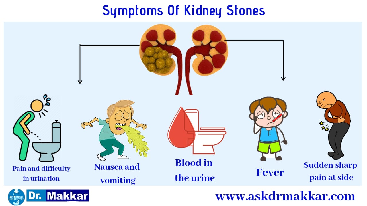 Symptoms of Kidney stones Urolithiasis renal calculi, nephrolithiasis or urolithiasis